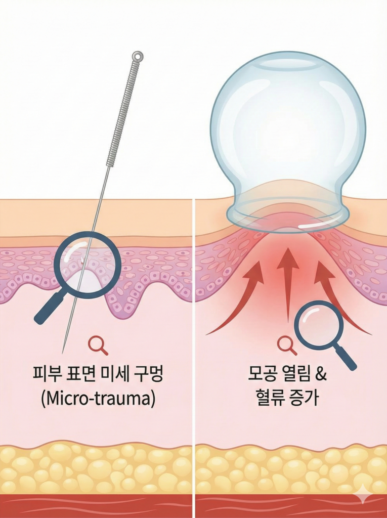 치료 후 목욕, 언제가 적절할까? 침 치료 후 목욕 (6)
